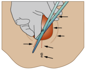 épisiotomie